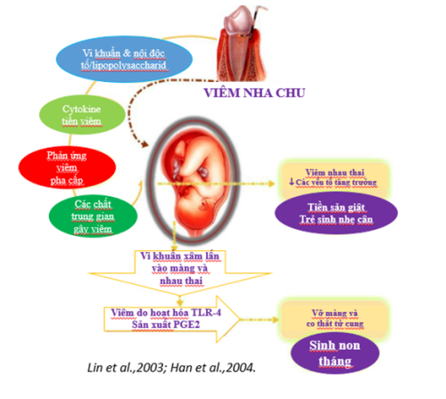 Viêm nha chu: Một trong các yếu tố gây sinh non - Sinh nhẹ cân 1